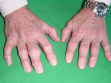 Arthrose des doigts