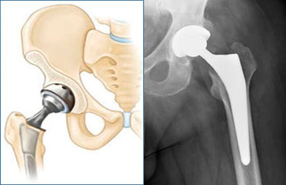 Arthroplastie complète de la hanche