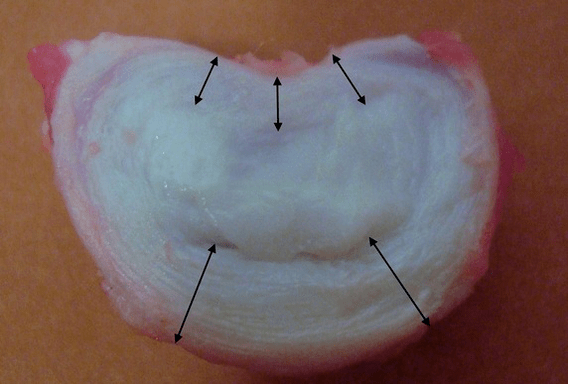 A quoi ressemble un disque intervertébral 
