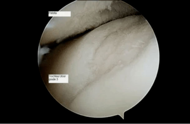 Vue astroscopique d'une articulation du genou atteinte d'arthrose de grade 3